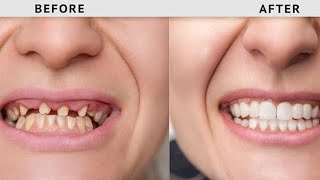 How To Teath Replacement By Dental Surgery||Dentist||Dental||Teath Treatment