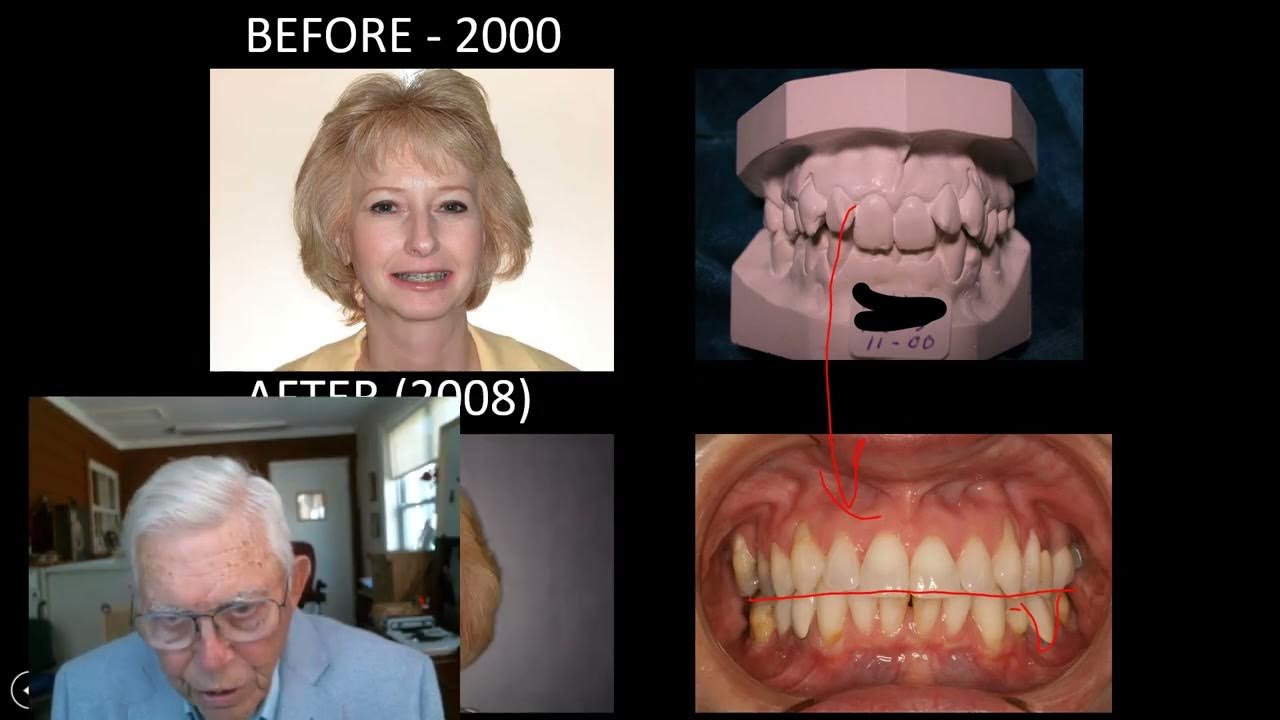 Orthodontics Closing Space On Adults YouTube