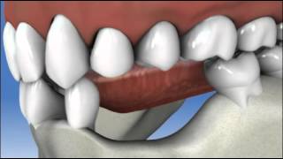 Multiple Teeth Implants
