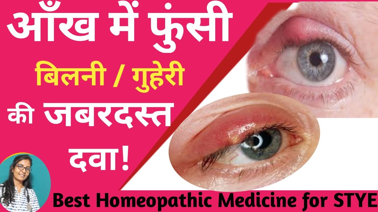 Homeopathic Medicines For Stye आँखों की गुहेरी(बिलनी)की जबरदस्त दवा
