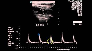 Bilateral Subclavian Artery Duplex - Case Study