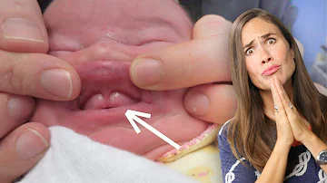 Do all babies have a lip tie?