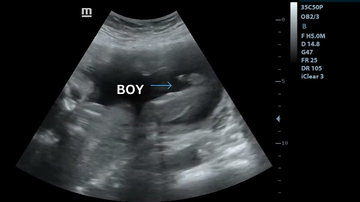 Ultrasound showing boy baby !!!🤰 | 23 weeks