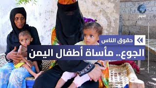 نصف مليون طفل يمني يعانون سوء التغذية الحاد.. هل من منقذ؟