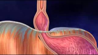 видео Грыжа пищевода. Причины, симптомы, диагностика