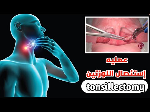 شاهد عمليه استئصال اللوزتين لأول مره بحياتك_Watch a tonsillectomy for the first time in your life