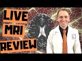Neurologist Reviews MRI Live (Multiple Sclerosis)
