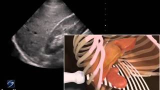 How To: EFAST - RUQ (Right Upper Quadrant) 3D Video