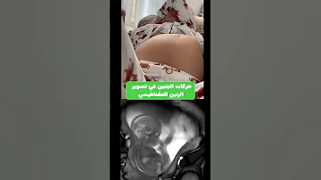 حركة الجنين داخل البطن خلال الحمل لمدة 9 أشهر 