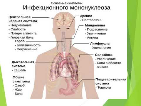 Инфекционный мононуклеоз