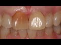 How to whiten single discoloured tooth? - Dentist in Skelmersdale