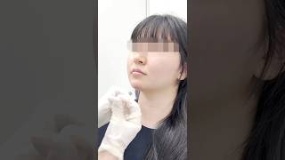 미인이 되기 위한 디테일 “턱끝필러”