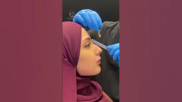 ڕێککاری لوت بە فیڵڵەر و بێ نەشتەرگەری 