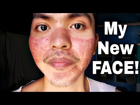My Fractional CO Laser Treatment Experience (TAGALOG)