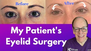 My Patient's Blepharoplasty | Eyelid Surgery Journey