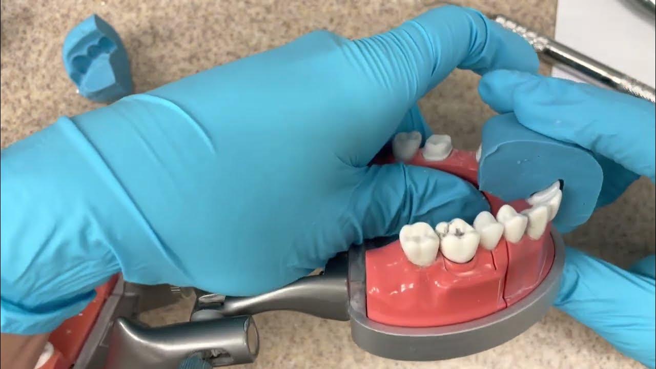 How to pass the CDCA ADEX Dental Exam Part 4 Prosth YouTube