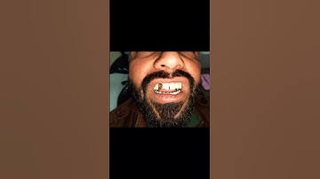 Thumbnail of Placement of a golden tooth . #dentistry #shorts #youtubeshorts #ytshorts