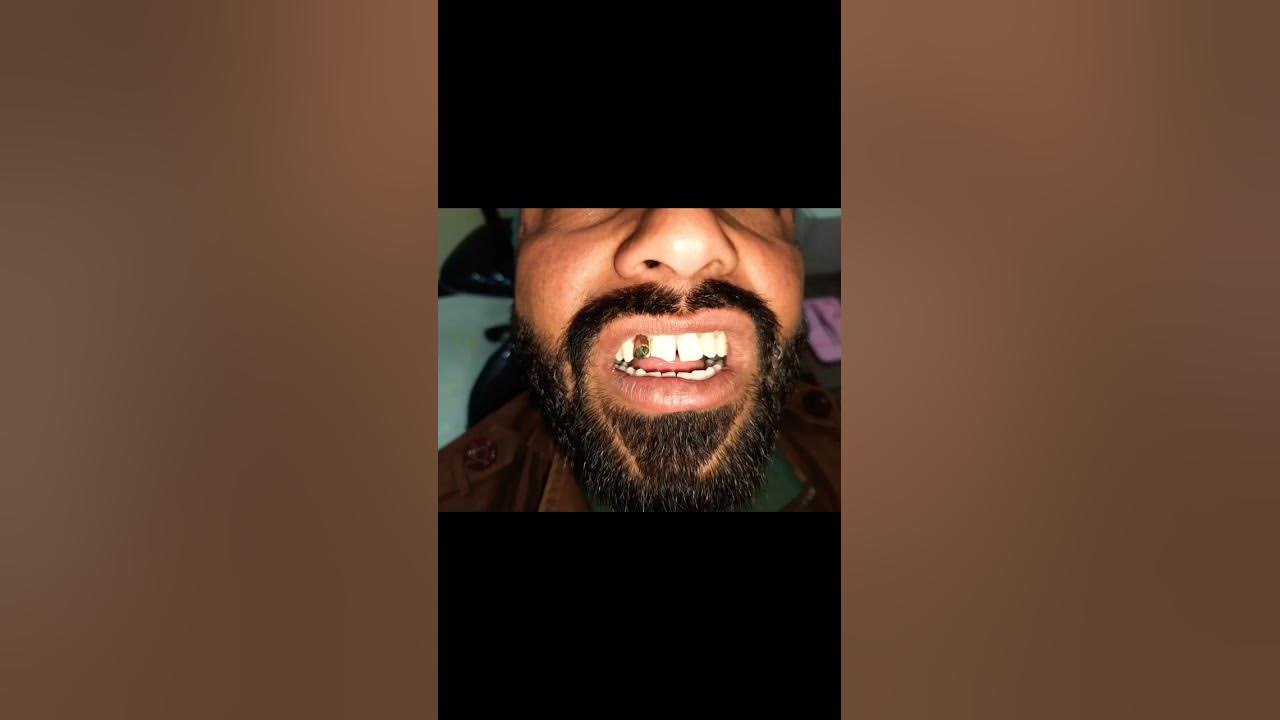 Placement of a golden tooth . #dentistry #shorts #youtubeshorts #ytshorts
