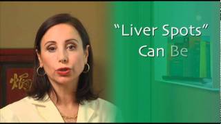 How to Treat Liver Spots
