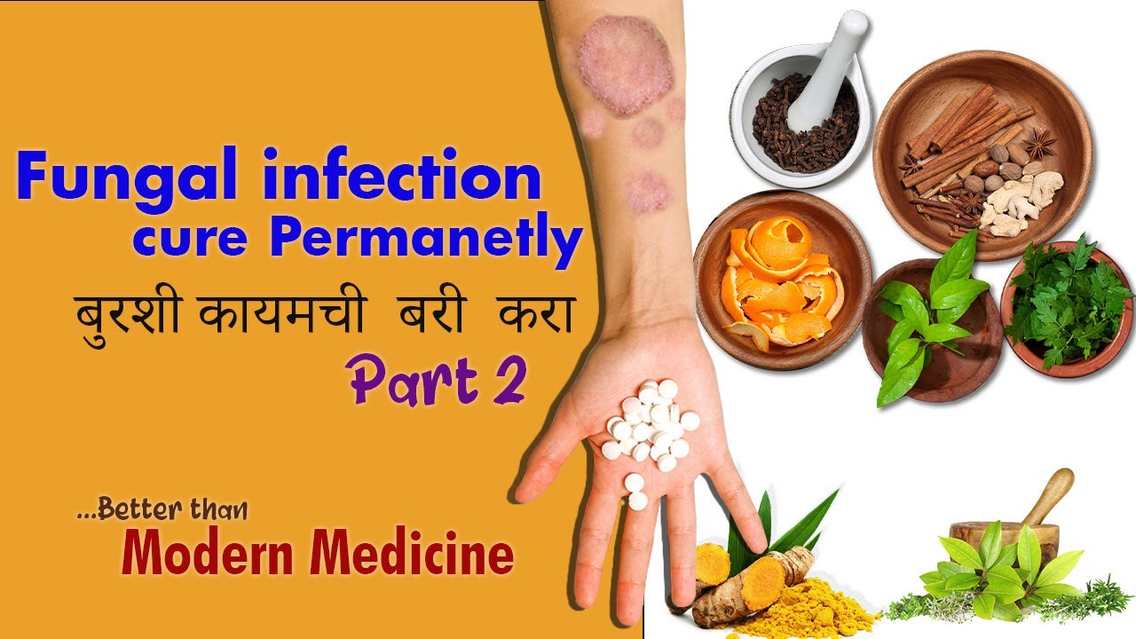 fungal infection treatment Cure fungal infection permanently