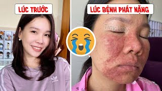 Bệnh viêm da dị ứng đã làm mình khóc rất nhiều + Kinh nghiệm điều trị