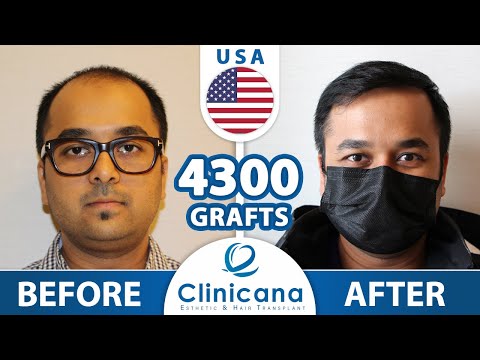 Zaid’s hair transplant