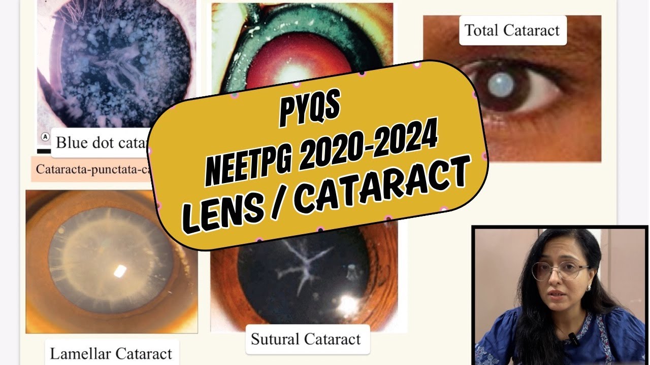 PYQs Ophthalmology | NEET PG 2020-24 | Lens / Cataract