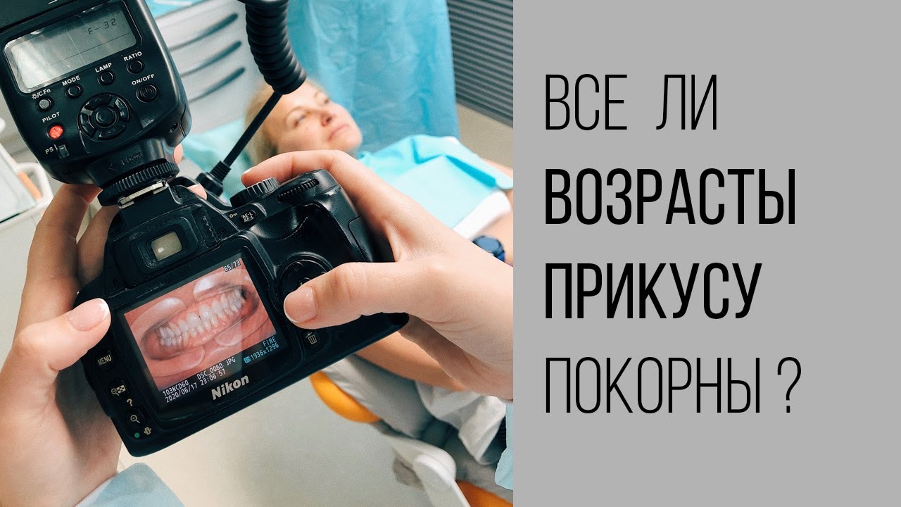 В каком возрасте лучше всего ставить брекеты?