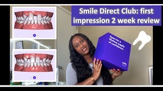Smile Direct Club Review | Missing Lateral Incisors