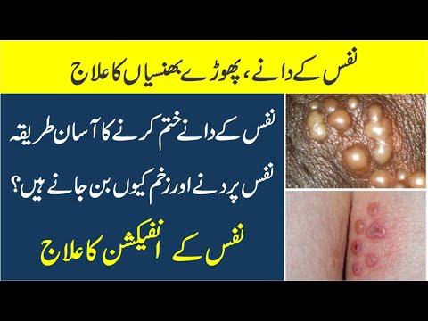 Nafs ke Dane Aur Zakham Wali Kharish Ka ilaj | Nafs pr dany ka ilaj | Herpes genitalis treatment