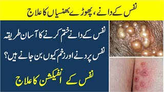 Nafs ke Dane Aur Zakham Wali Kharish Ka ilaj | Nafs pr dany ka ilaj | Herpes genitalis treatment screenshot 5