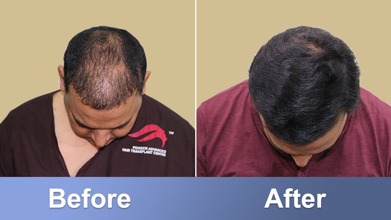 Hair Transplant in Chennai | Best cost and best results By India's top  surgeon - YouTube