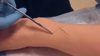 Simple Interrupted Sutures