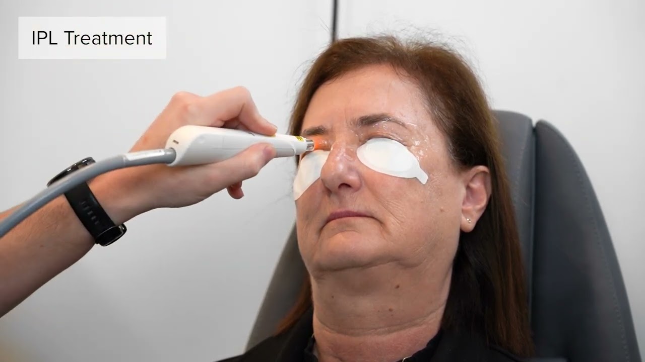 Dry Eye IPL Treatment Available at George & Matilda Eyecare