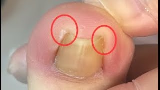 Pedicure Tutorial:  Ingrown toenail Drills into toe meat and cause pain