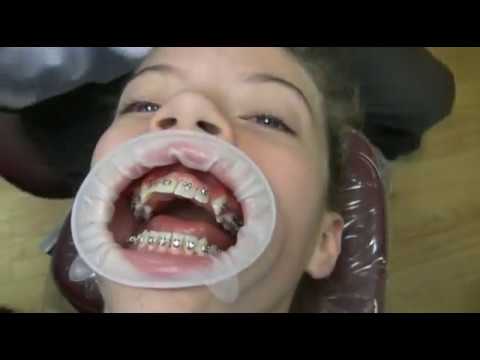 Watch: How to Put Braces