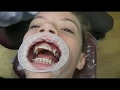Watch how we put your braces on!