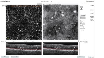 CNV Type III on OCTA