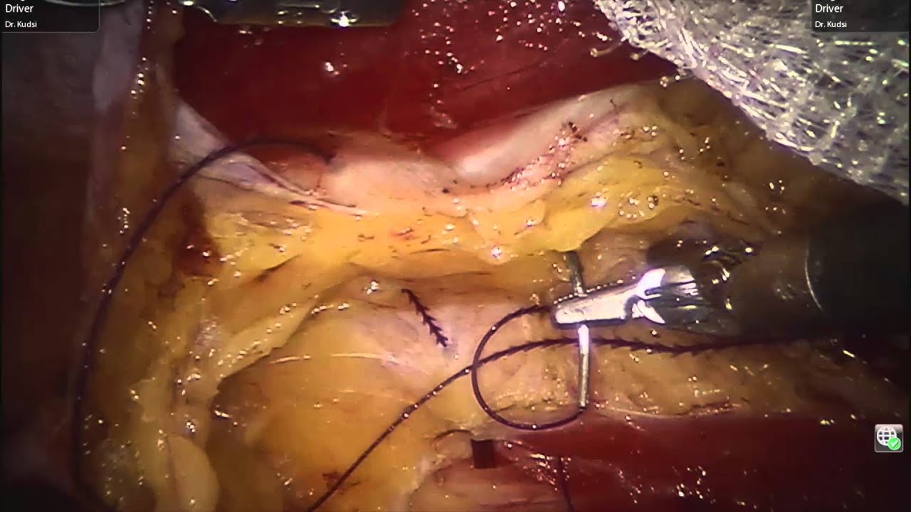 sharingbox Robotic Rives-Stoppa