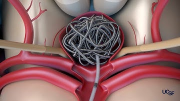 Surgical Treatment Options for Brain Aneurysms | Ethan Winkler, MD, PhD