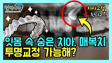 1-45 설마 이게 투명교정으로 될까?? 매복치도 투명교정으로 교정 가능할까??