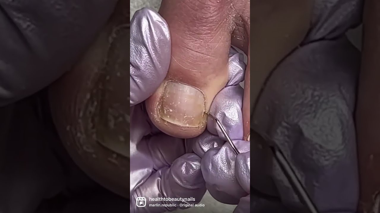 Satisfying Dead Skin Removal Pedicure Satisfyingvideo Nailtutorial Waterlesspedicure