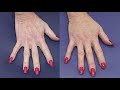 Young Hands! Rejuvenate Your Hands with Lipo Fat Injections