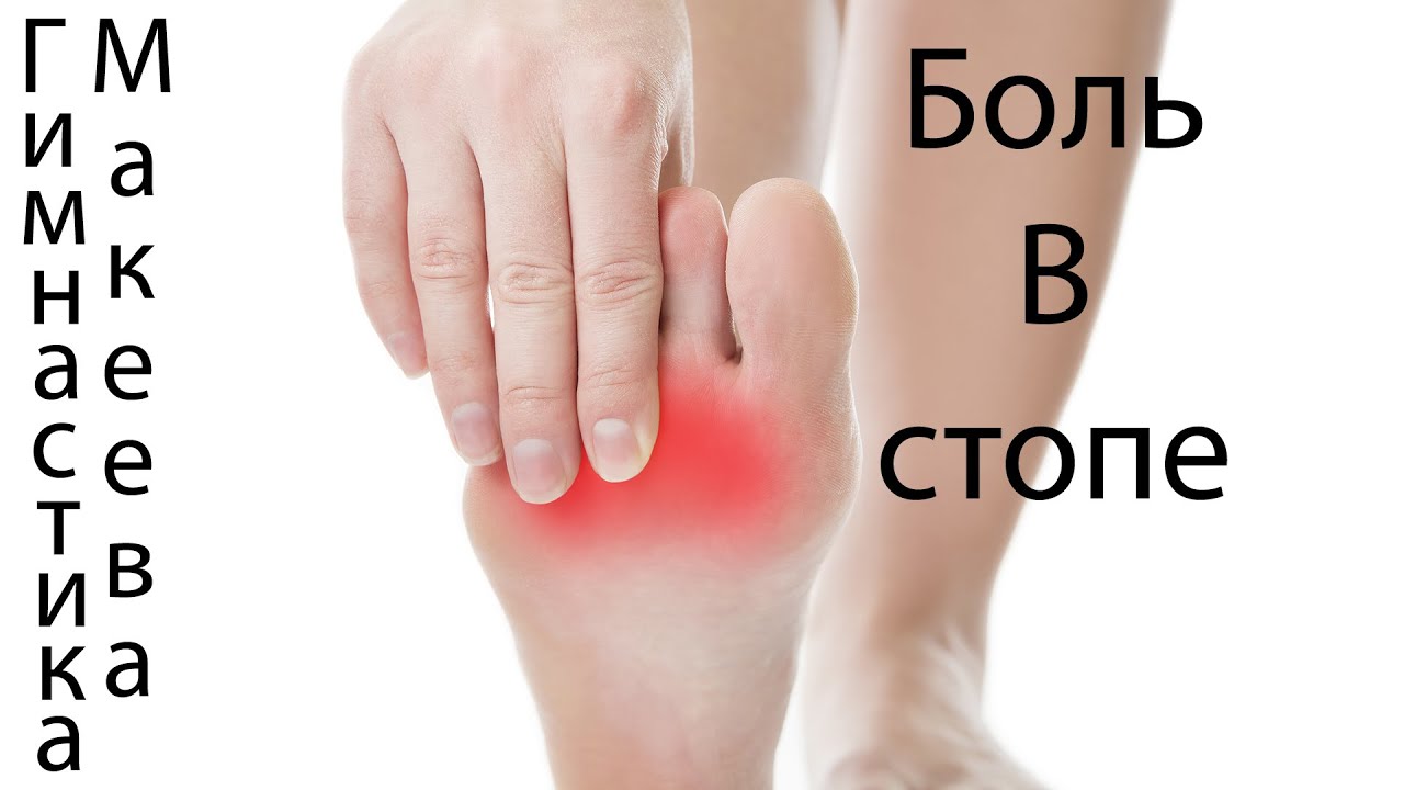 Боль и жжение в стопе. Неврома Мортона. - YouTube