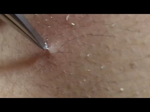 008 角栓 背中 Keratin Plug Youtube