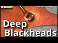 Deep blackhead removal by drlalit kasana  new  22june 2022