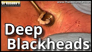 DEEP BLACKHEAD Removal bỳ Dr.Lalit Kasana / New Video ( 22June 2022)