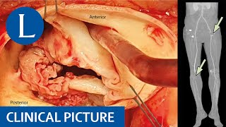 Antiphospholipid syndrome following Q fever