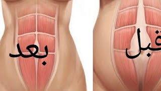 أختبار أنفصال عضلات لبطن ونصائح للتخلص منلأنفصال للتخلص من البطن