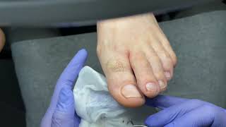 картинка: ПЕДИКЮР ПАЛЬЦЕВ | чешется между пальцев 🫩